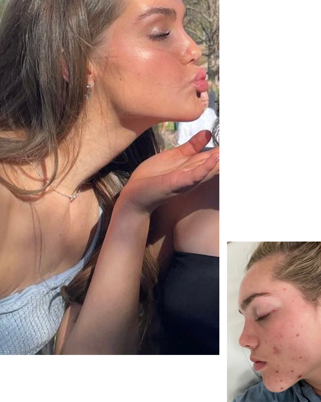 stay clear beauty's client before and after photos. She is throwing a kiss in her after photo and has acne in the before. 